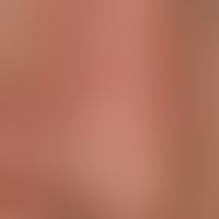 Hidrocystoma: General view: For about 2-3 years, formation of disseminated, colorless, painless, ...