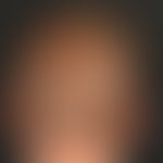 Dysplasie, hidrotische ektodermale: helle, ausgedünnte kurze Haare.
