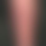 Hypodermitis: extensive reddening and induration of the lower leg. Painful if finger pressure is ...