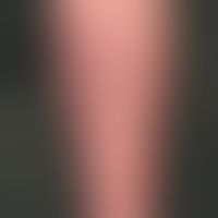 Hypodermitis: extensive reddening and induration of the lower leg. Painful if finger pressure is ...