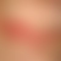 Intertrigo: bright red blurred flake-free (pretreatment), submammary plaque with satelliteosis (c...