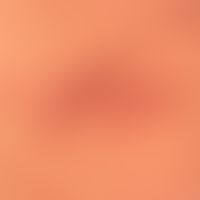 Follikulitis: gelbliche follikuläre Pusteln.

