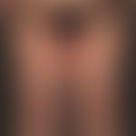 Lineare IgA-Dermatose:&nbsp;symmetrisch verteilte, urtikarielle Plaques mit gestaffelten Bläschen...