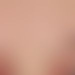 Alopezie: Ulerythema ophryogenes mit Ausfall der lateralen Augenbrauenpartien.
