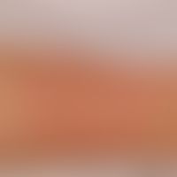 Solitary, acute, flat, moderately sharply bordered, hardly elevated, skin-coloured, little increa...