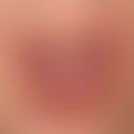Lichen planus verrucosus: Lichen planus mucosae known for years with continuous verrucous transfo...