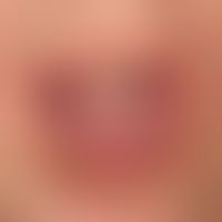 Lichen planus&nbsp;mucosae: verruköse Umwandlung der Läsionen an Lippen und Mundschleimhaut.
