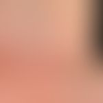 Lichen planusLichenplanus classic type: for several months site-specific, red, moderately itchy, ...
