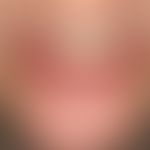 Lichen planus mucosae: erosive Lichen planus mucosae with painful erosive cheilitis.
