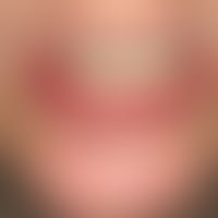 Lichen planus mucosae: erosiver Lichen planus mucosae mit schmerzhafter erosiver Cheilitis.
