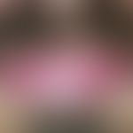Lichen planus of the lip red. white-striped, not wipeable, smooth spot and plaque formation of th...