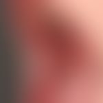 Differenzialdiagnose der&nbsp;Leukoplakie: retroangulär lokalisierter &nbsp;Lichen planus mucosae...