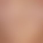Lichen sclerosus et atrophicus generalized. large-area, symmetrical infestation with parchment-li...