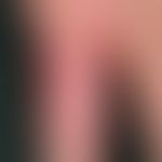 Swimming pool granuloma. general view: Since several months, continuously growing, completely pai...