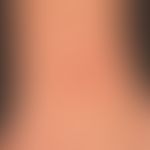 Swimming pool granuloma: localized, flat, centrally ulcerated and crusty, painless lump, existing...