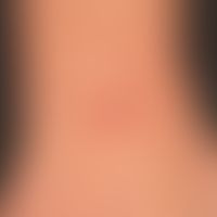 Schwimmbadgranulom: lokalisierter,&nbsp; flacher, zentral ulzerierter und krustiger, schmerzloser...