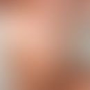 Melanosis neurocutanea: melanozytäres Hamartom mit großflächigem phylloidem Muster. "Neurofibrom-...