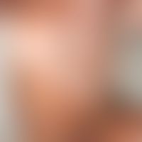 Melanosis neurocutanea: melanozytäres Hamartom mit großflächigem phylloidem Muster. "Neurofibrom-...