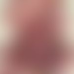 Melanosis neurocutanea:large congenital melanocytic nevus with extensive infestation pattern and ...
