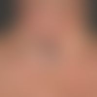 Malformation, venöse:&nbsp;venöse Malformation mit blaue-roten Papeln und Knoten, großem, weichem...