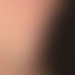 Malformationen, venöse:&nbsp;venöse Malformation mit blau-roten Papeln und Knoten, großem, weiche...