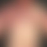 Klippel-Trénaunay syndrome: extensive vascular malformation with extensive nevus flammeus affecti...
