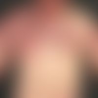 Klippel-Trénaunay syndrome: extensive vascular malformation with extensive nevus flammeus affecti...