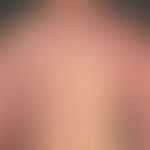 Klippel-Trénaunay syndrome: extensive vascular malformation with extensive nevus flammeus affecti...