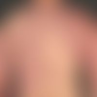 Klippel-Trénaunay syndrome: extensive vascular malformation with extensive nevus flammeus affecti...