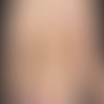 Naevus flammeus: &nbsp;angeborener, asymmetrisch angelegter, nicht-syndromaler (keine Gewebehyper...