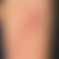 Naevus flammeus:&nbsp;harmloser, angeborener, asymmetrischer, und asymptomatischer, nicht-syndrom...