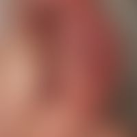 Naevus flammeus lateralis.&nbsp;Scharf begrenzter, asymptomatischer, livid-bläulicher Fleck mit s...