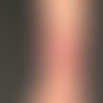 Naevus flammeus:&nbsp;harmloser, angeborener, asymmetrischer, und asymptomatischer, nicht-syndrom...