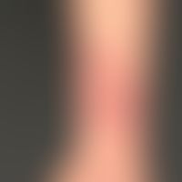 Naevus flammeus:&nbsp;harmloser, angeborener, asymmetrischer, und asymptomatischer, nicht-syndrom...