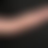 Naevus flammeus lateralis.&nbsp;Kongenitale, generalisierte, fleckige Erytheme am linken Arm bei ...