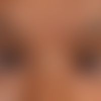 Kollodiumbaby: ausgeprägtes Ektropium bei einem&nbsp;inzwischen 4-jährigen Kind.
