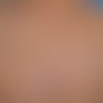 Ichthyosis X-linked recessive: ichthyosis occurring only in the male sex with massive, dark polyg...