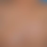 Ichthyosis X-linked recessive: ichthyosis occurring only in the male sex with massive, dark polyg...