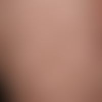Ichthyosis X-linked recessive: ichthyosis occurring only in the male sex with a massive, dark pol...