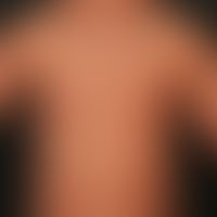 Ichthyosis vulgaris autosomal dominant: universal desquamation.
