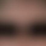 Hyperpigmentierung: flächige, gleichmäßige Hyperpigmentierung bei metastasiertem malignem Melanom.
