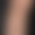 Melanom malignes:&nbsp;multiple Melanom-Metastasen (s. eingekreiste Stellen)
