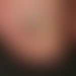 Melanonychia striata with complicating onychomycosis
