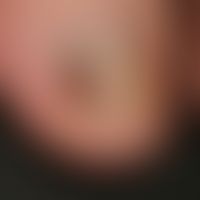 Melanonychia striata with complicating onychomycosis
