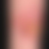 Bowen's disease with transition to Bowen's carcinoma: solitary, size-progressive plaque that has ...