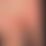 Bowen's disease: chronically stationary, slowly increasing in area and thickness, sharply defined...