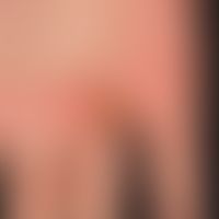 Bowen's disease: chronically stationary, slowly increasing in area and thickness, sharply defined...