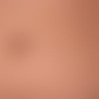 Malformations vascular: Blue-rubber-bleb syndrome with deeply cutaneous/subcutaneously situated, ...