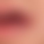Malformationen venöse (nicht-syndromale, gemischt,&nbsp;kapillär/venös): angeborene, zunächst led...