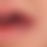 Malformationen venöse (nicht-syndromale, gemischt,&nbsp;kapillär/venös): angeborene, zunächst led...
